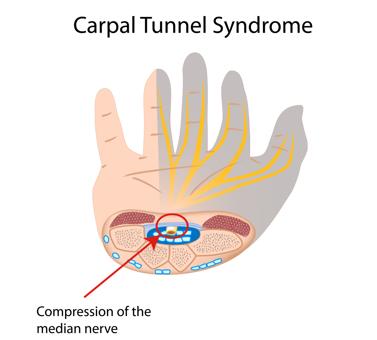 What to Expect After Carpal Tunnel Surgery A Personal Experience