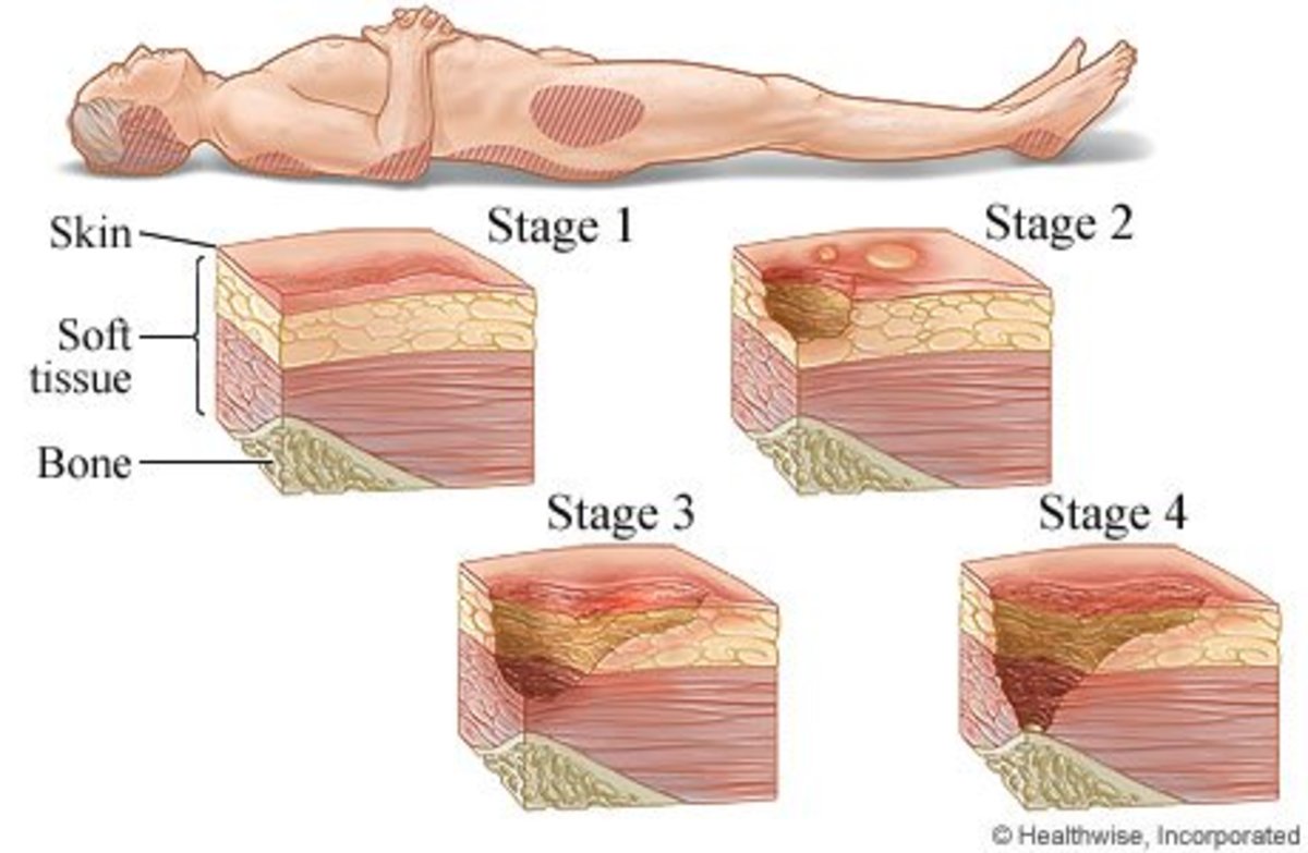 Pressure Ulcers Cause HubPages