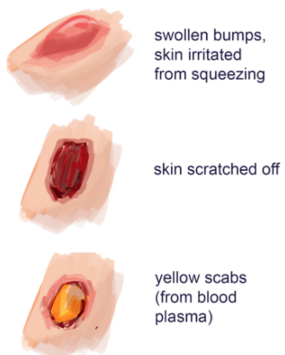 Skin marks that are a consequence of skin-picking. Swollen bumps are from frequent small nibs or squeezing. Smooth red spots that might bleeding are from scratching and oozing spots occur from both when a spot is picked over and over again.