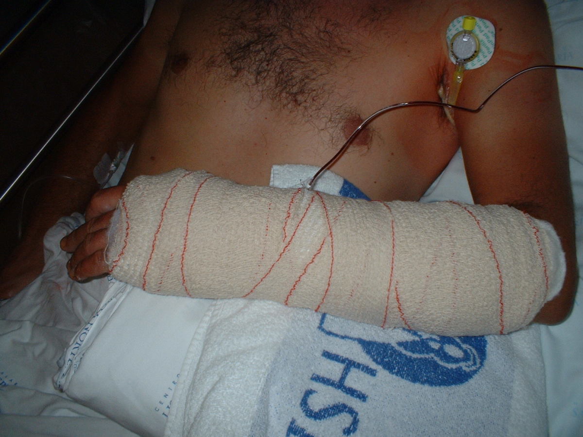Just after the last surgery (October 2009)