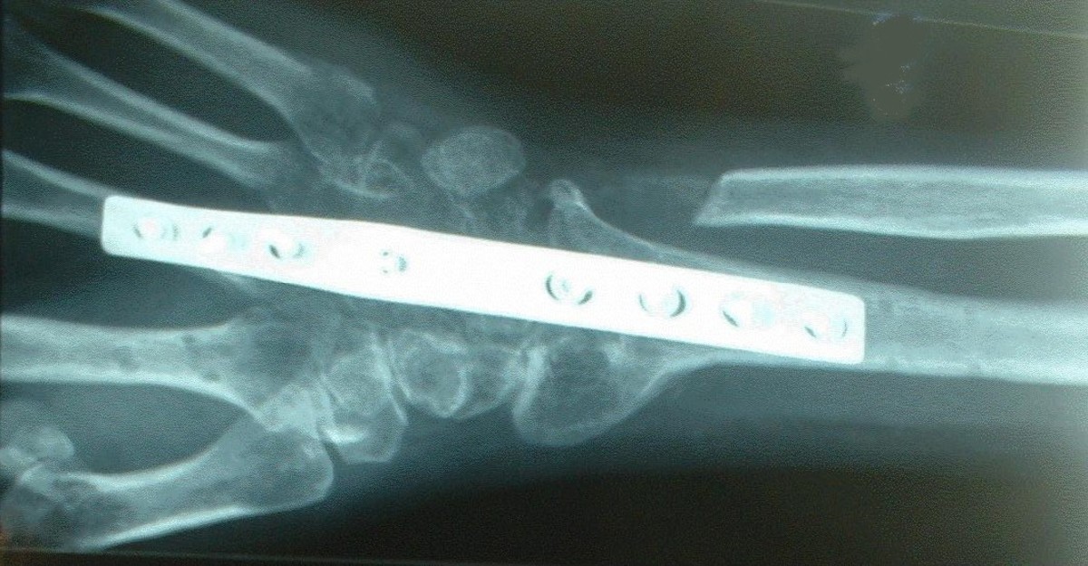 They also remove (cut) the distal end from the cubitus bone to allow hand rotation