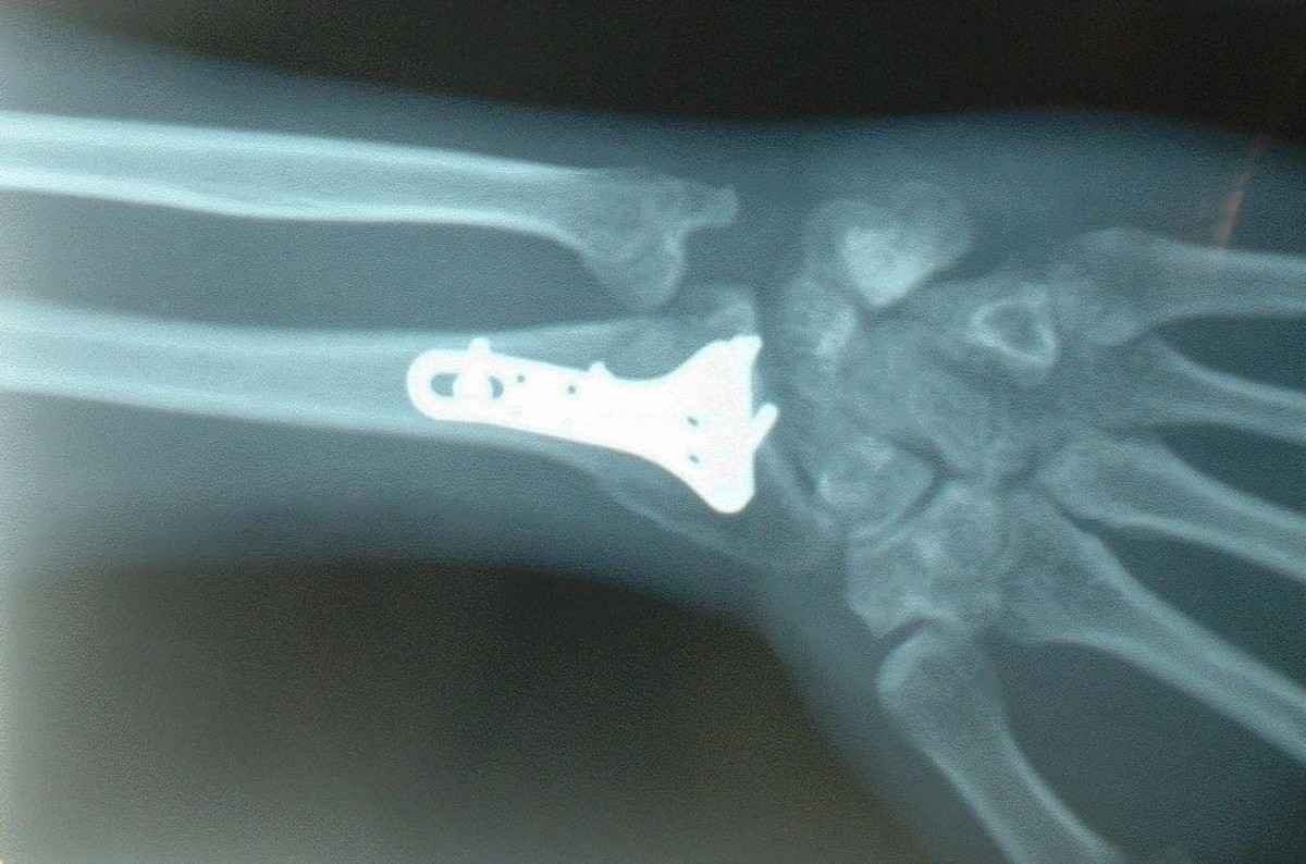 My left wrist (view from below) with the titanium plate and screws inserted during surgery to hold the bones in the proper position
