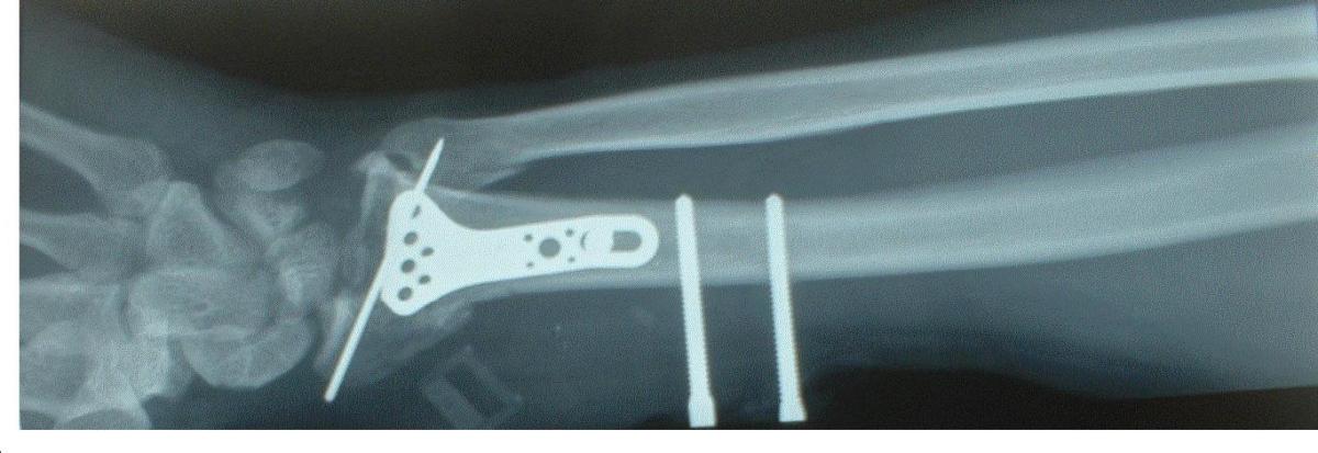 My right wrist (view from below) with the titanium plate, screws and external fixation inserted during surgery to hold the bones in the proper position