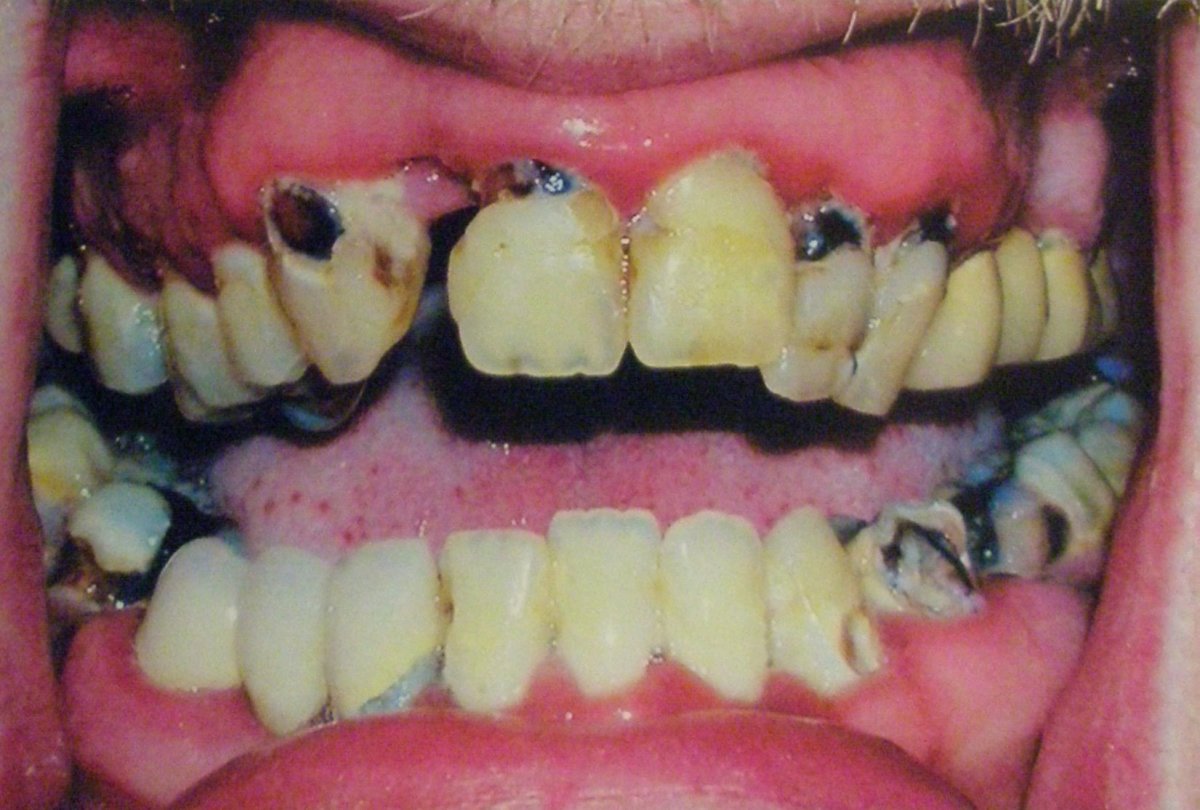 "Meth mouth"—one can see how devastating the use of methamphetamine is on the body, including the teeth.