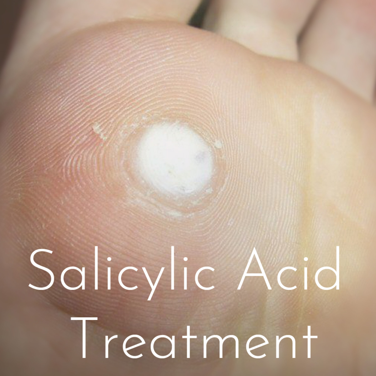 Plantar wart after treatment with salicylic acid.