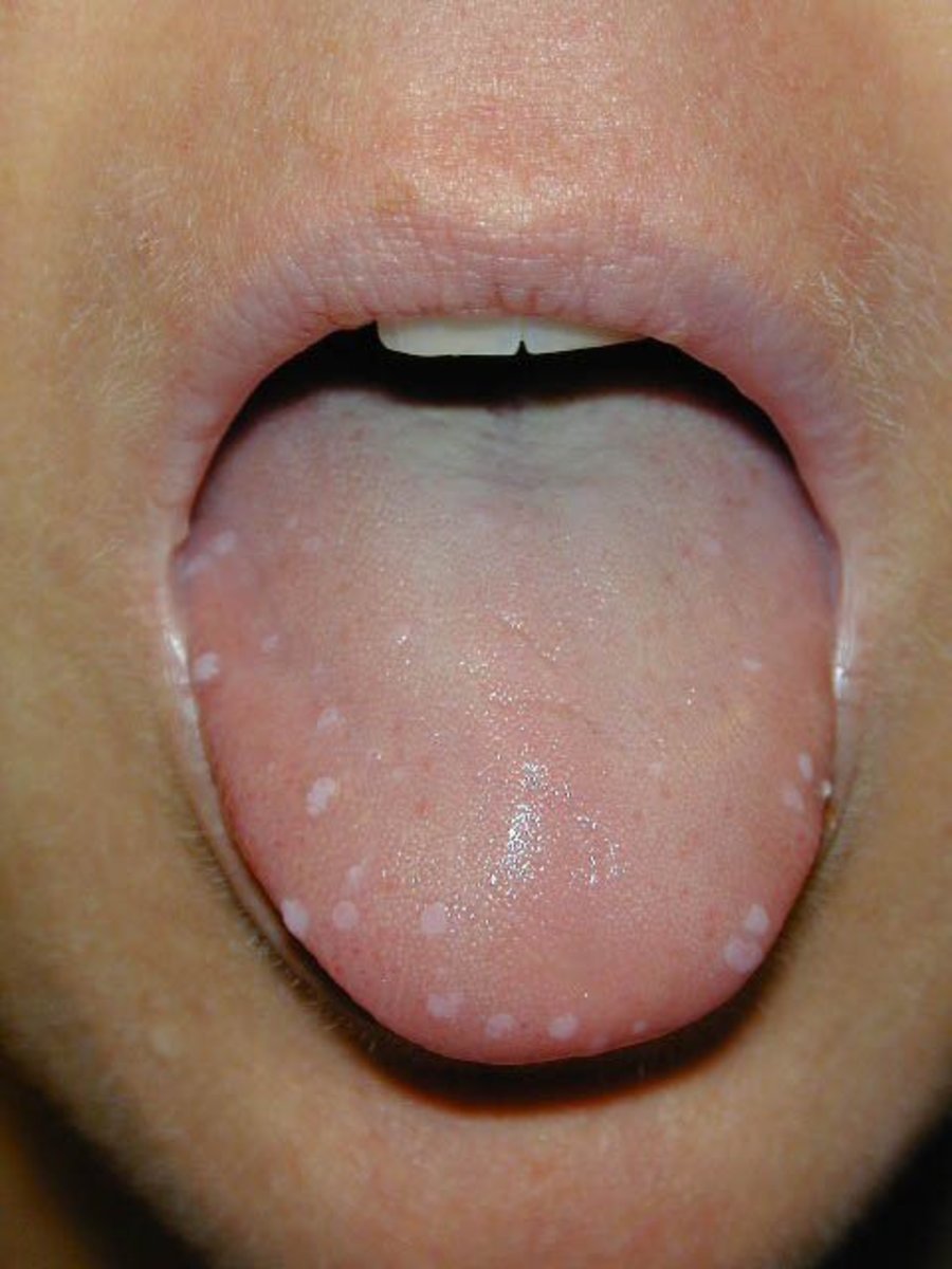Tongue Warts