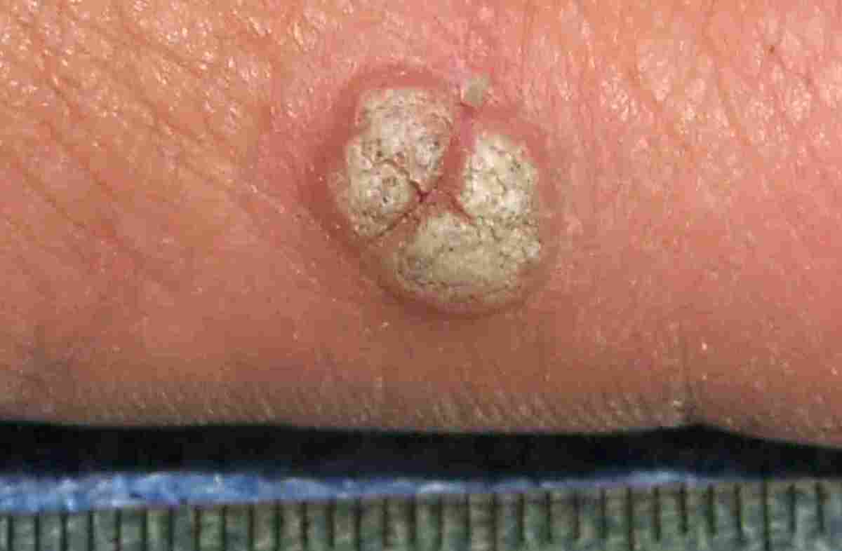 Common Wart on Finger