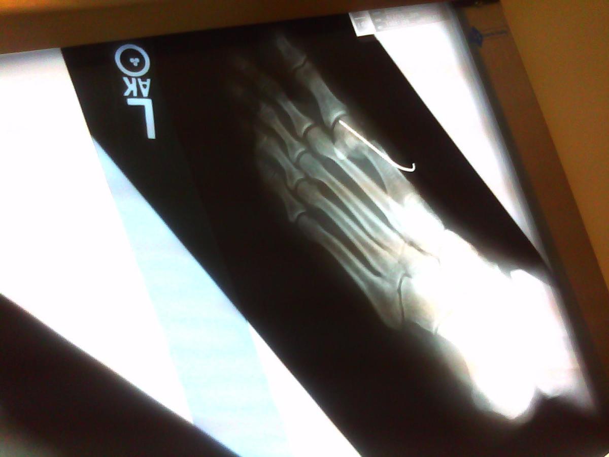 The metal pin inserted to hold my toe straight is visible in this X-ray, six weeks after bunion correction surgery.