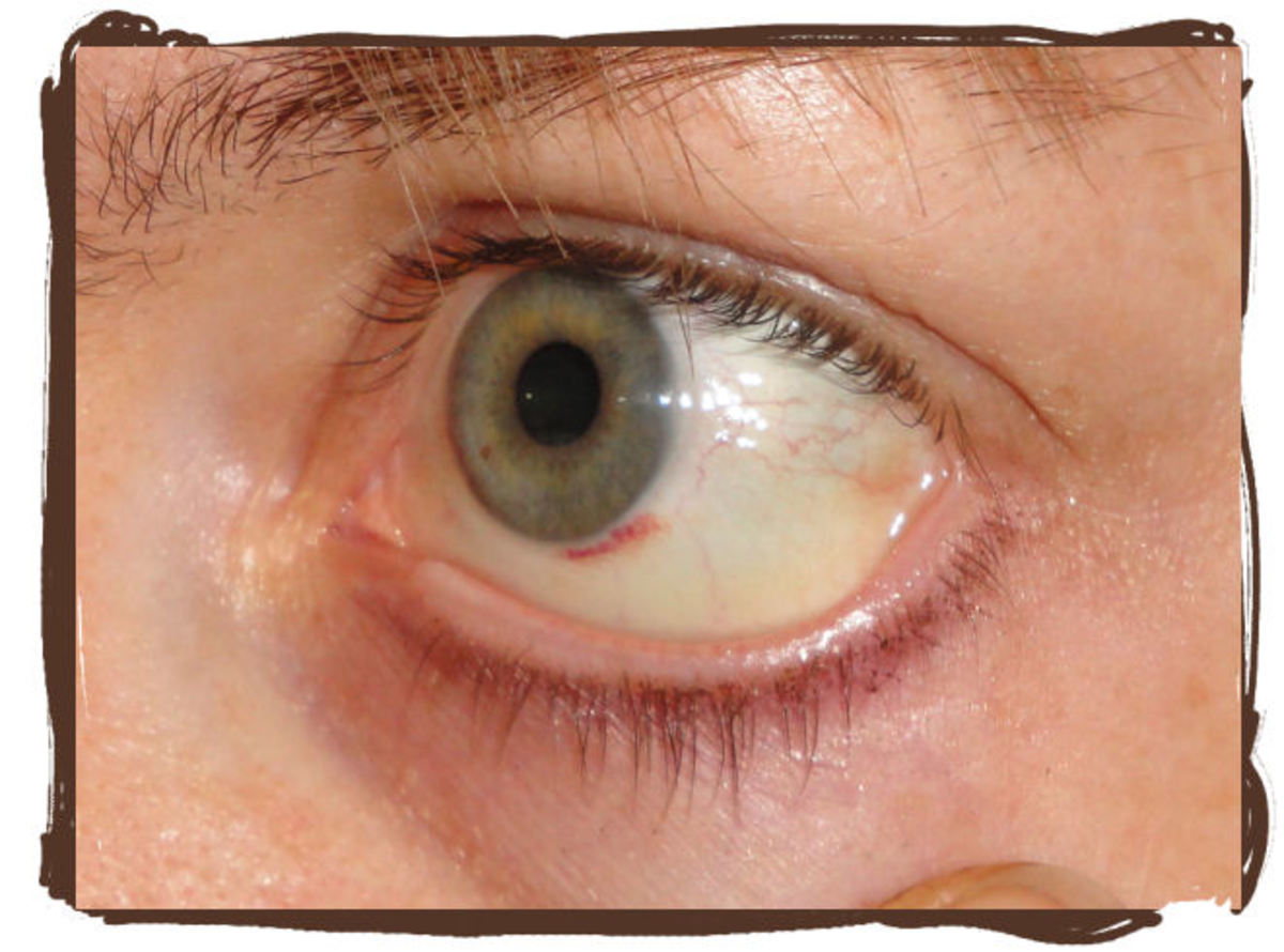 Day 8: Almost gone. Yay! The reddest part is just a small spot near my iris