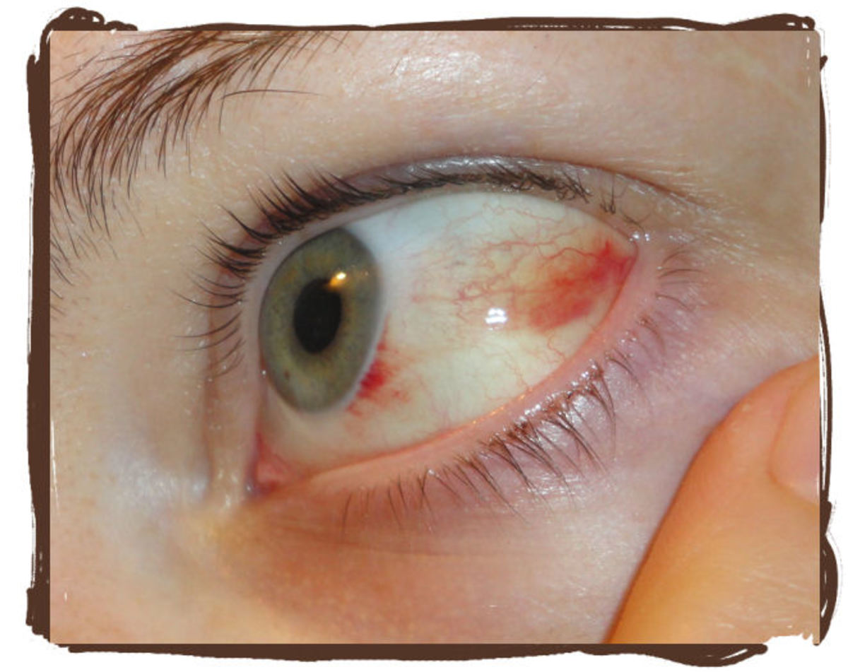 red ring around pupil of eye