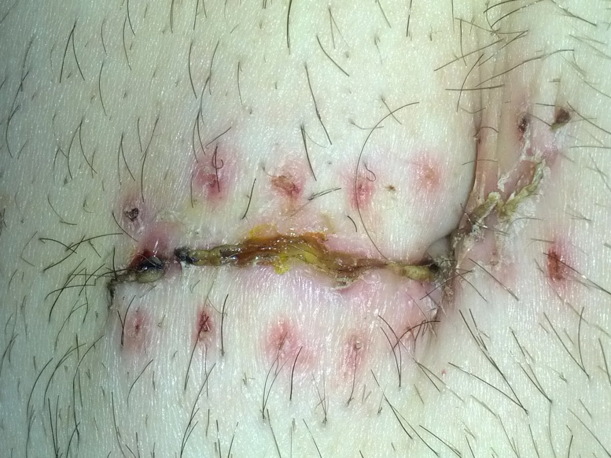 This my incision after the staples were removed.