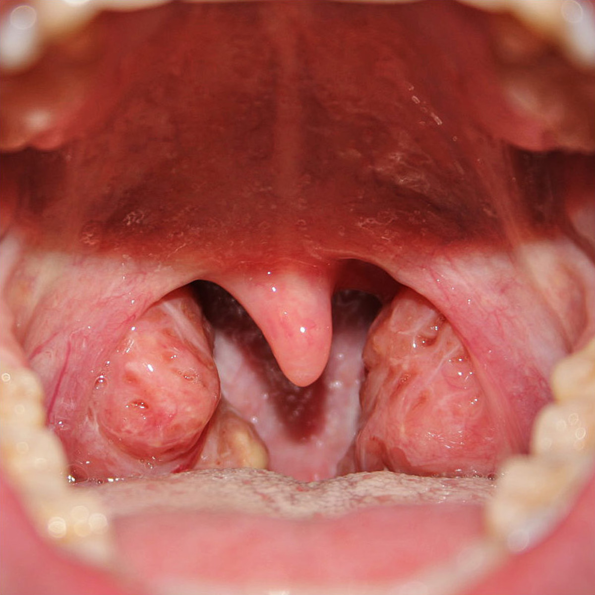 Your doctor will take a look at your tonsils to determine if you have tonsillitis. 