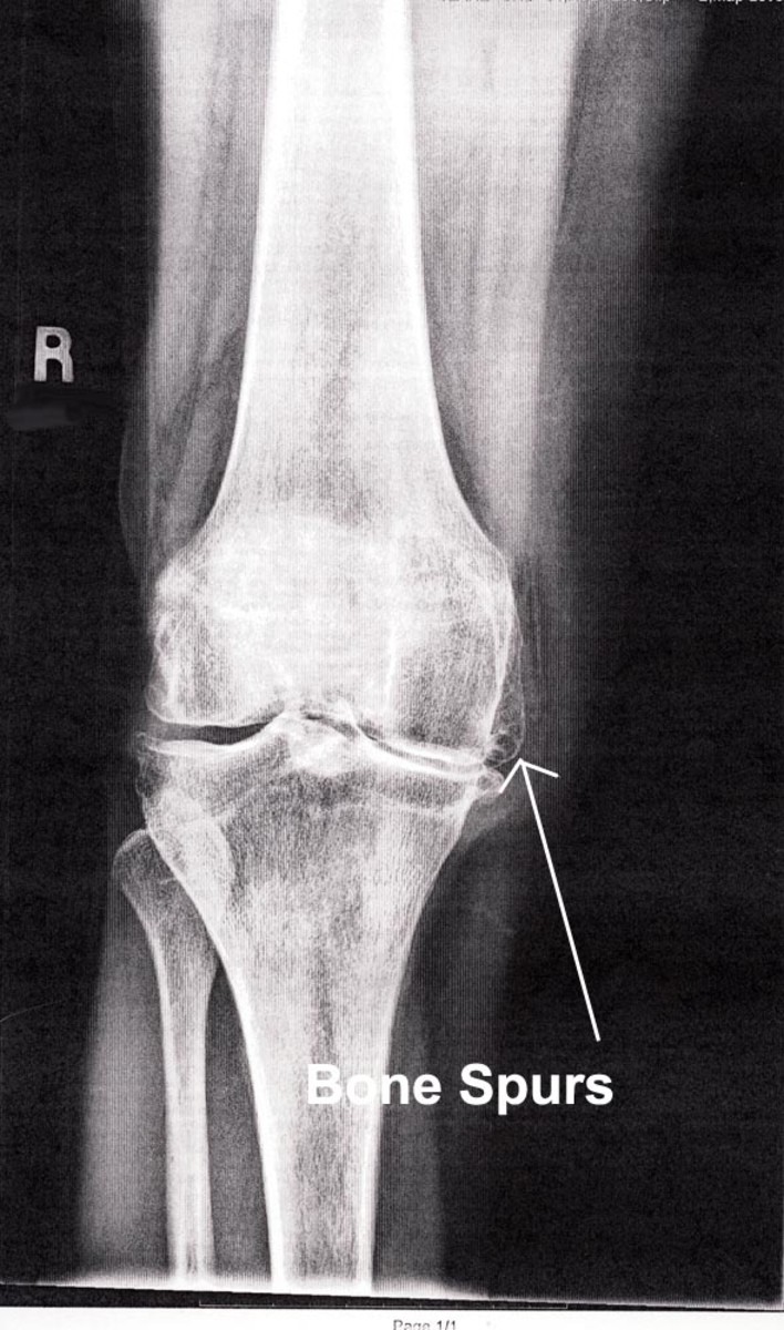 X-ray of arthritic knee, front view