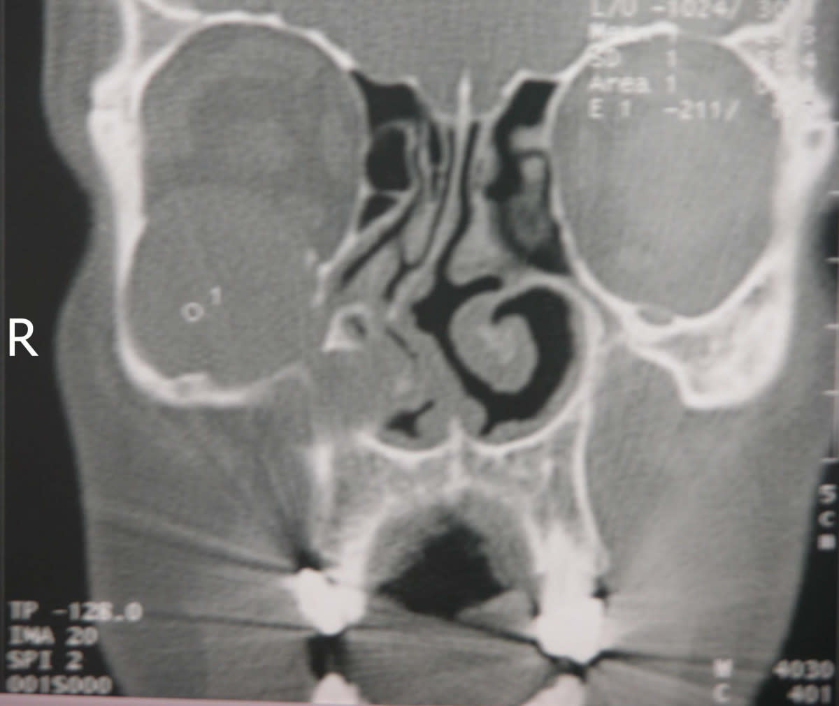CT scan of a mucocele pushing eye down