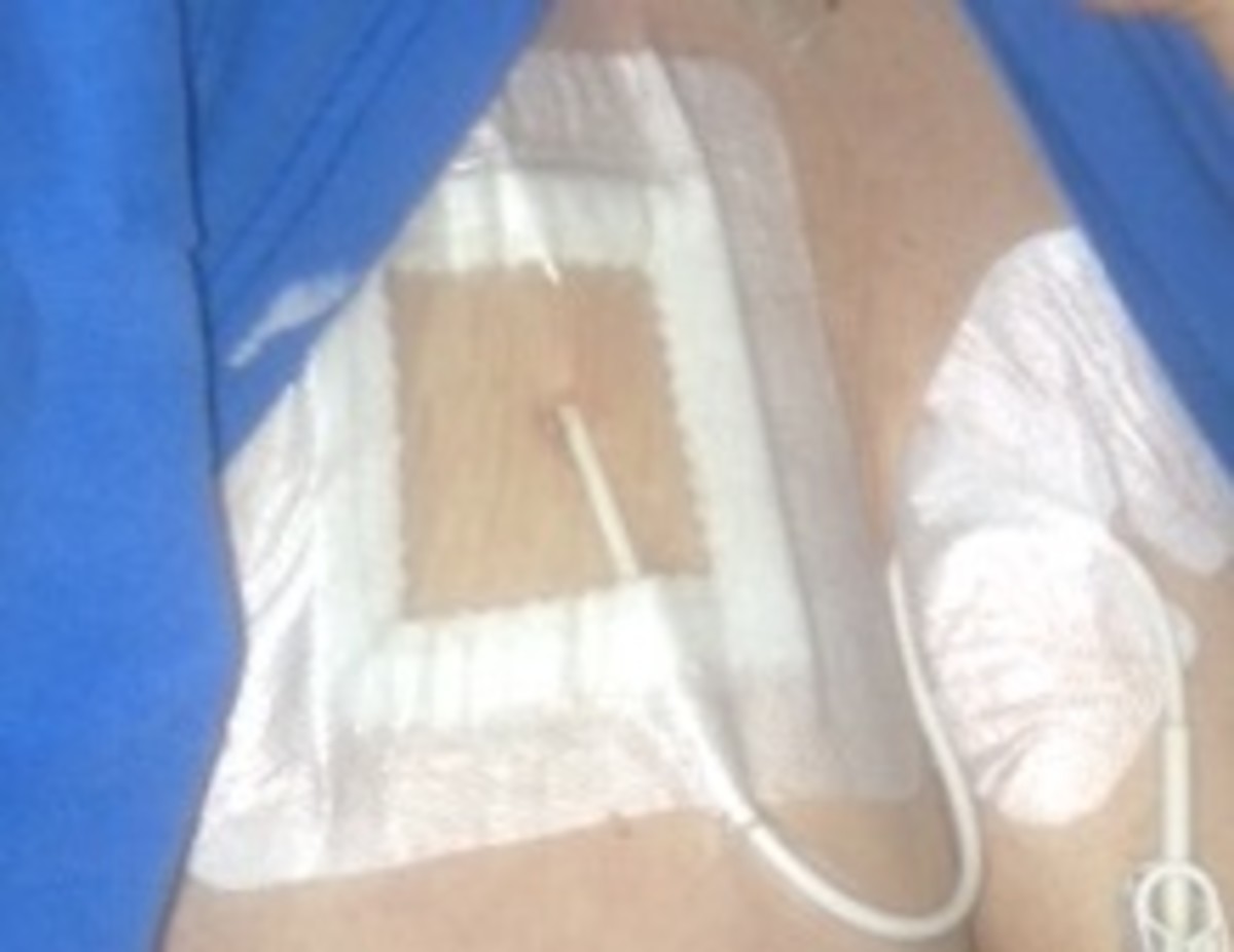 This is a picture of a HICKMAN catheter placed via a central line for use with TPN