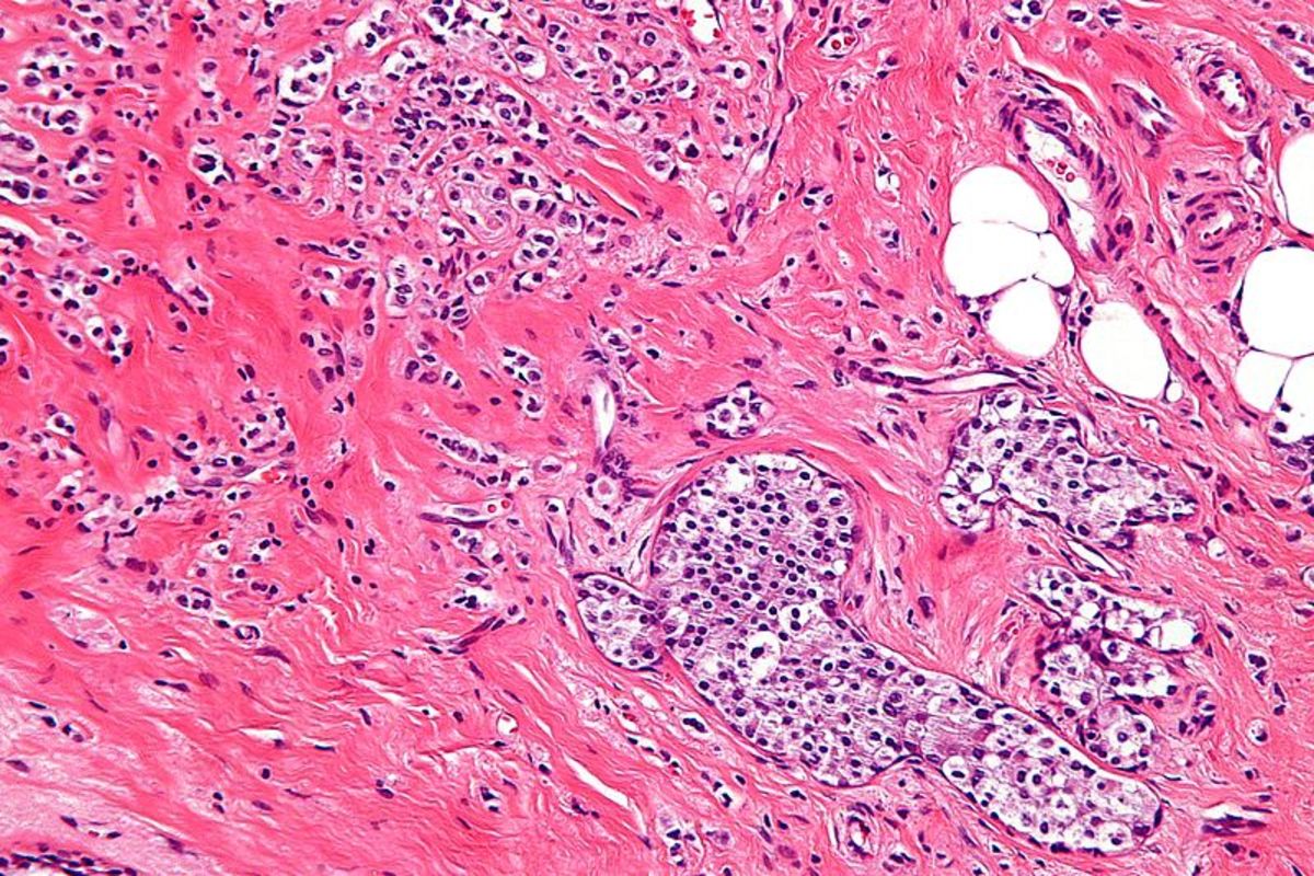 High magnification micrograph of lobular breast cancer.