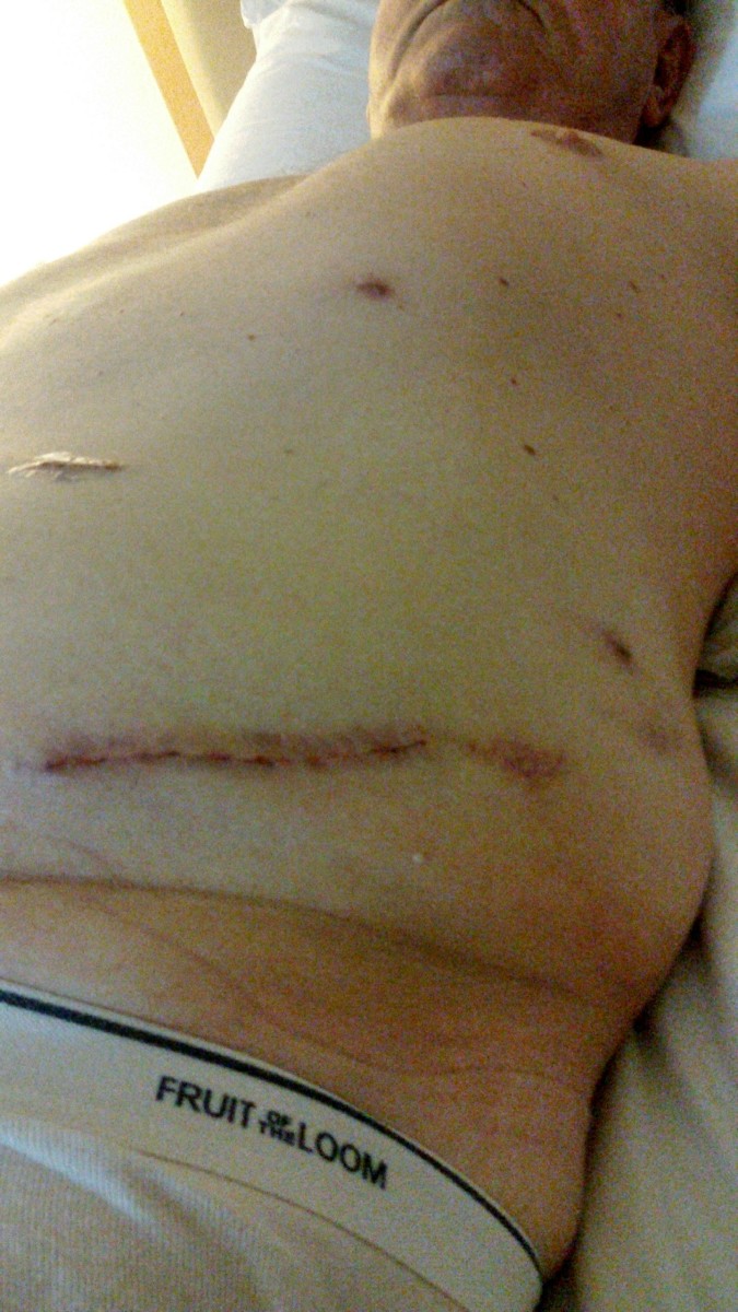 Scar from my left kidney removal operation.  Picture taken in Bumrungrad Hospital around April 28, 2015, two or three days after the operation.