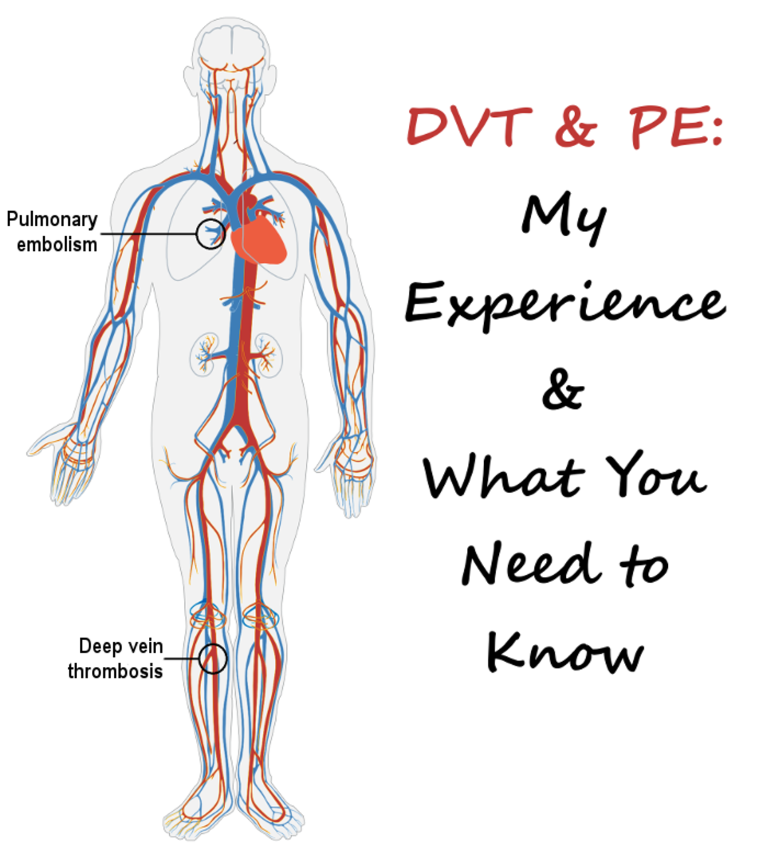 DVT and PE: Causes, Symptoms, Treatment, and Prophylaxis