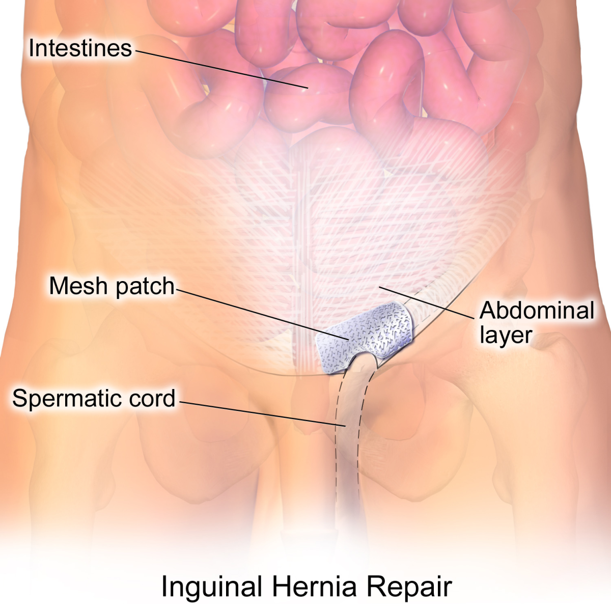 Top Doctor Offering Groin Hernia Repair