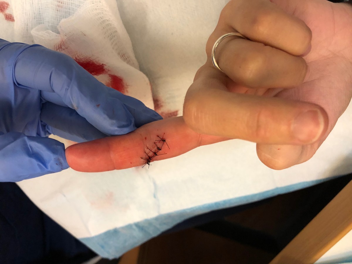 Here's a photo of my finger immediately after the Urgent Care physician finished stitching it.
