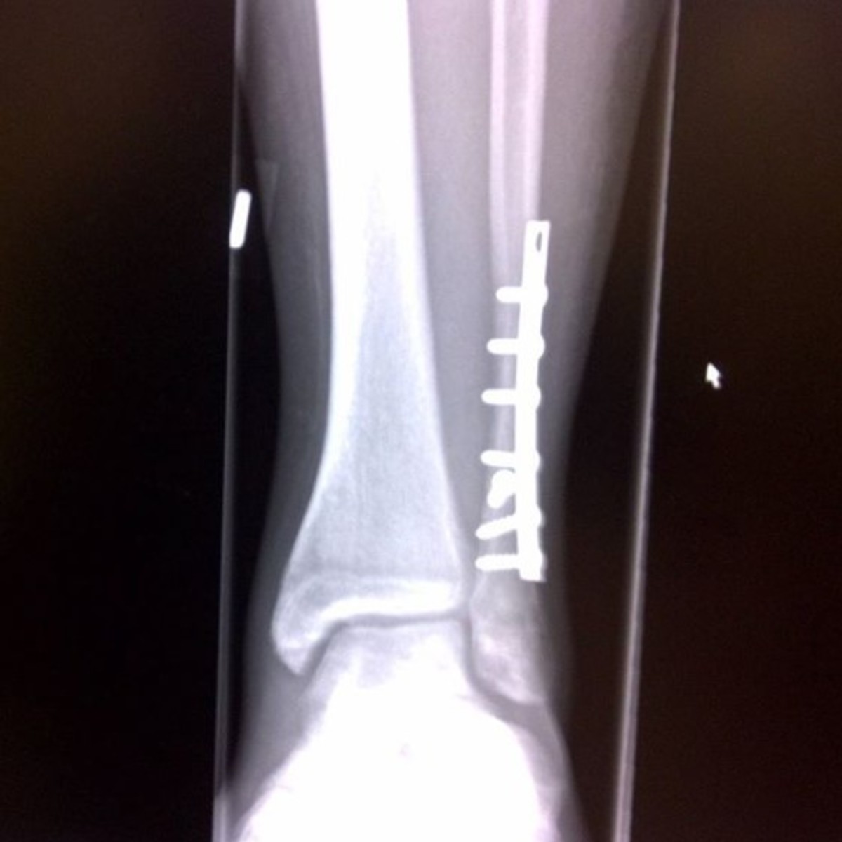 My surgically repaired ankle with a titanium plate and seven screws. 