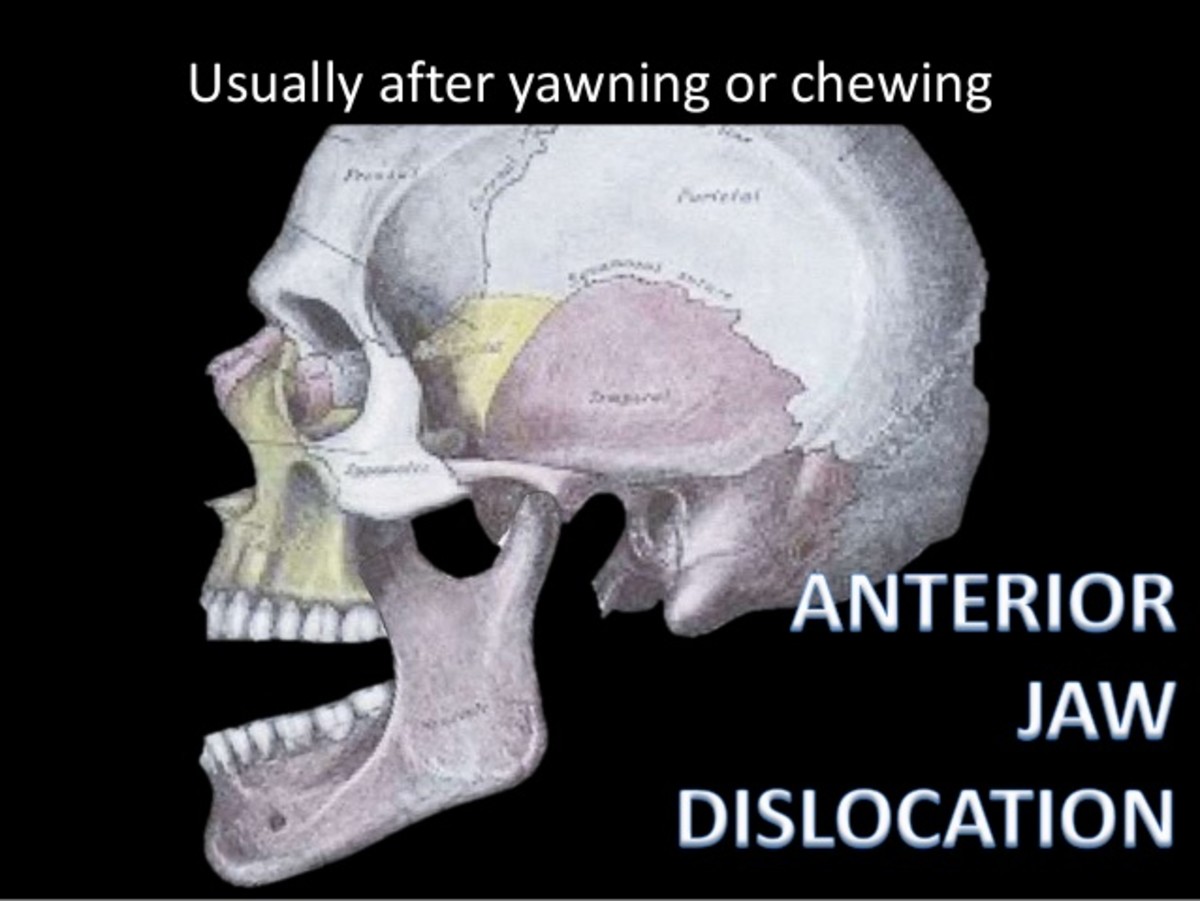 Anterior jaw dislocation