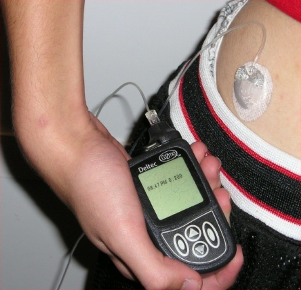 A person with diabetes using an insulin pump is pictured here.