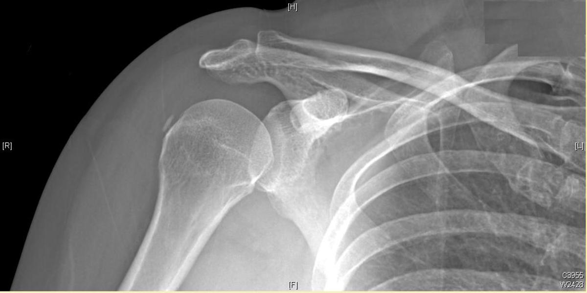 X-ray of right shoulder