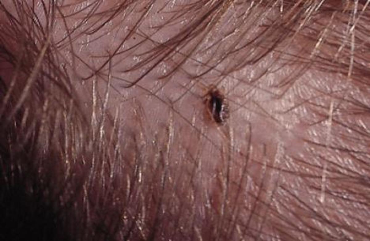An adult louse residing close to a human scalp.
