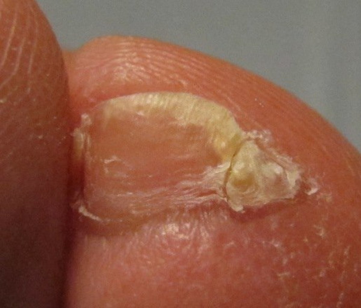 Accessory Nail on the Pinky Toe
