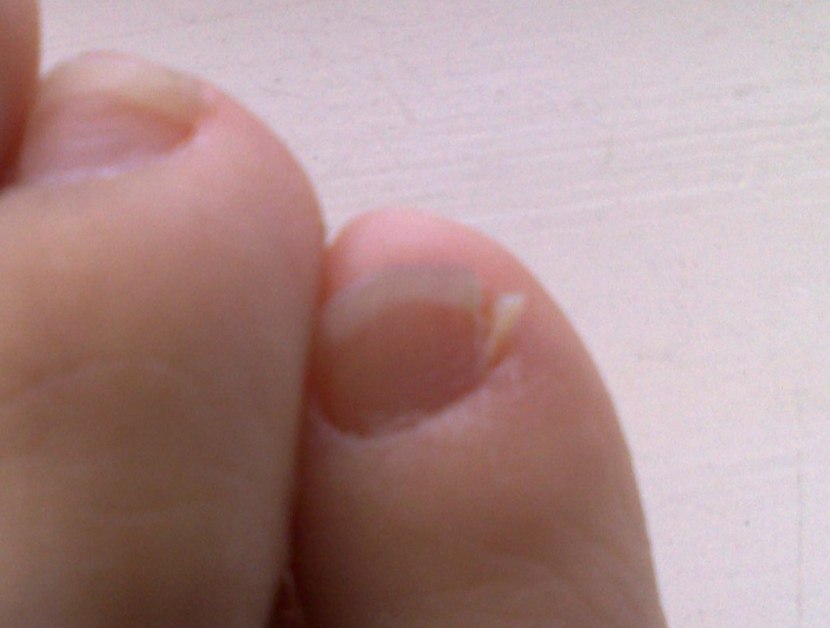 cracked pinky toe