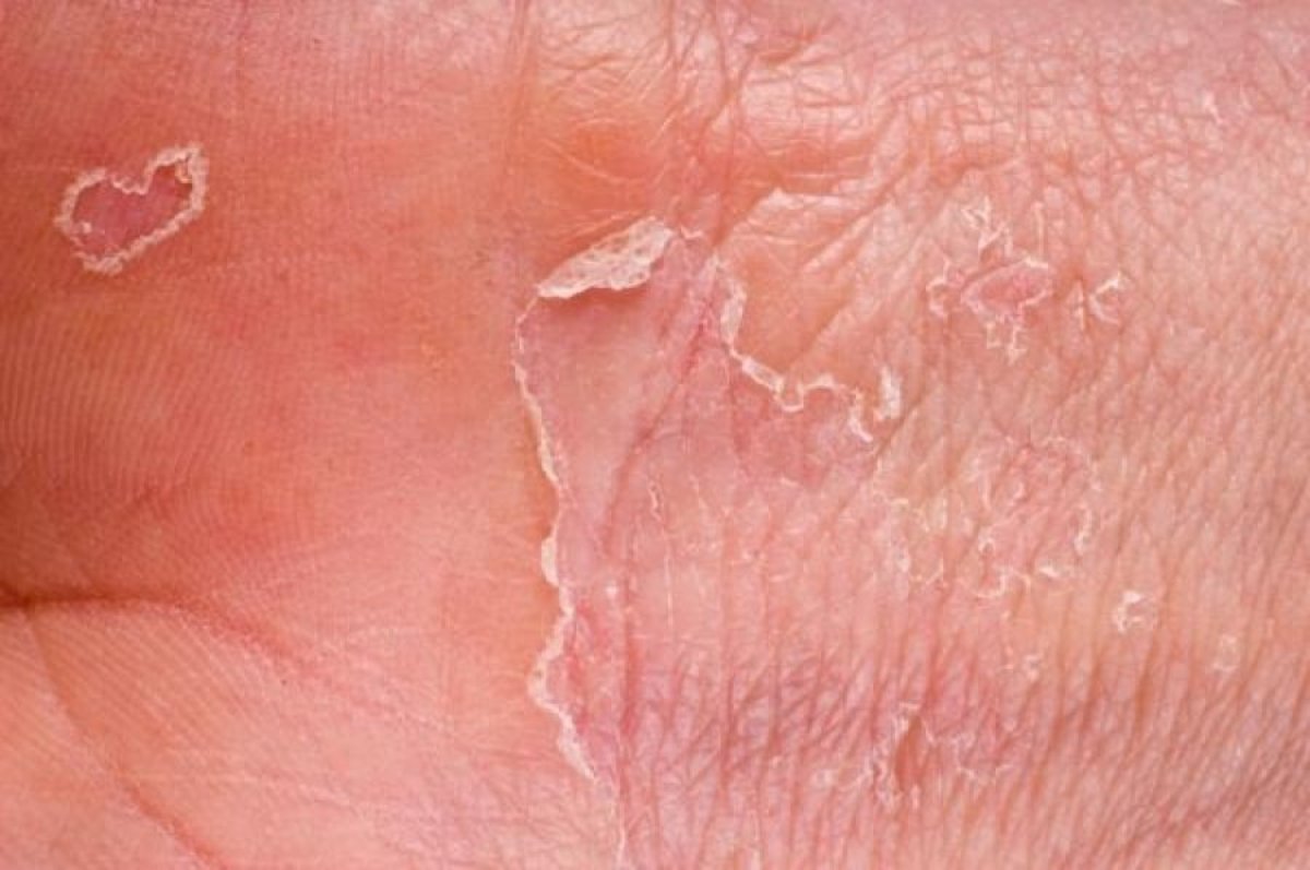 How to treat eczema with treatments at home and over the counter remedies