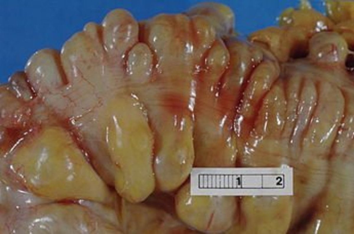 A section of the large bowel showing multiple diverticula  in the sigmoid colon