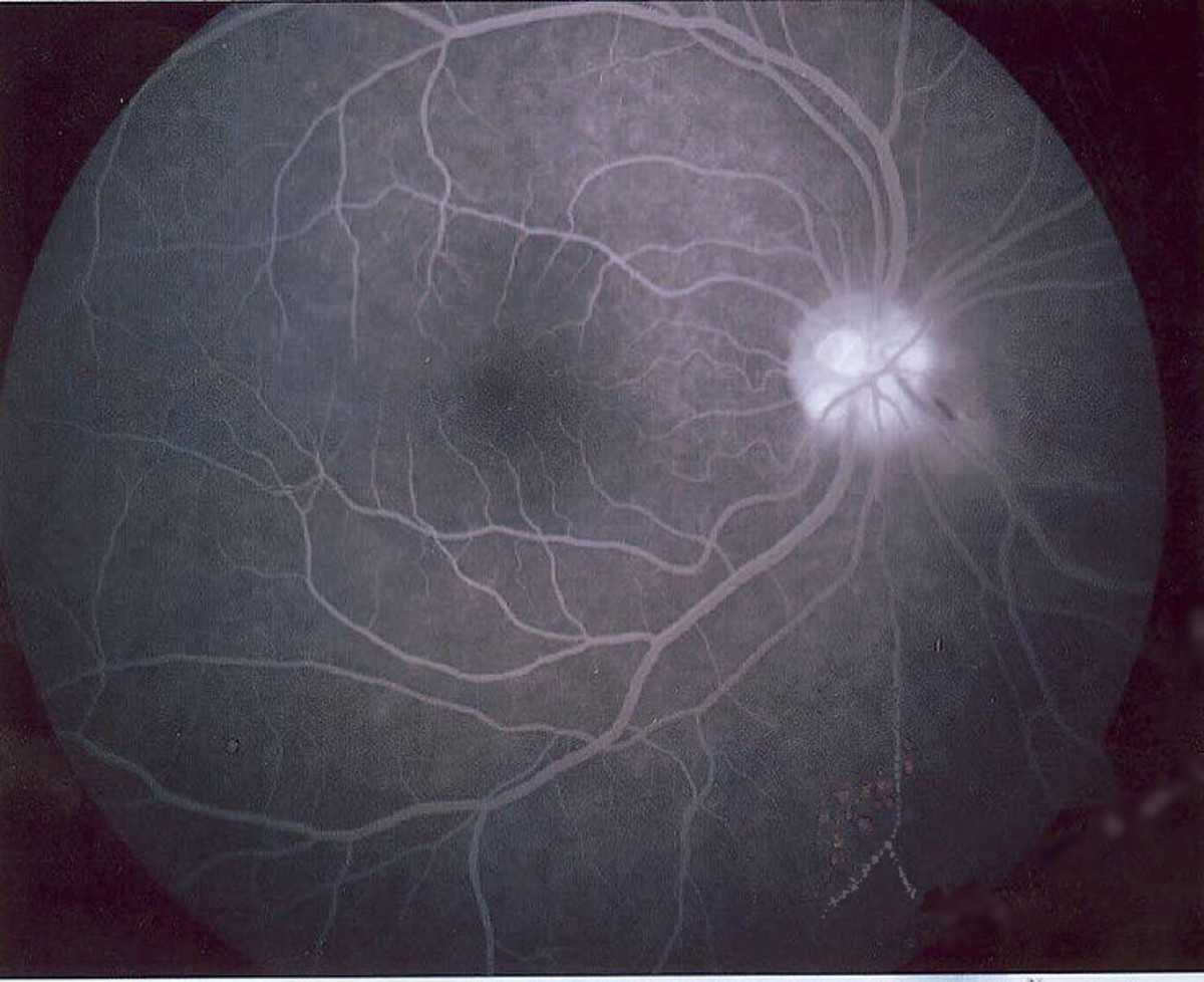 An example of a photo taken during a fluorescein angiogram.