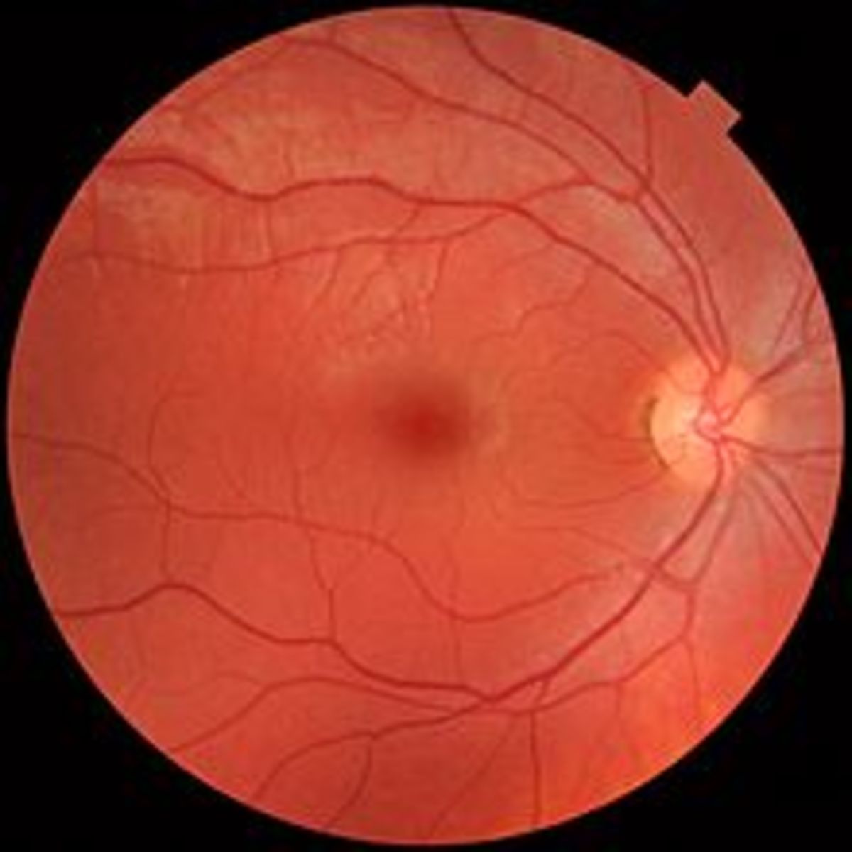 This image shows what an ophthalmologist sees upon examination of the fundus.