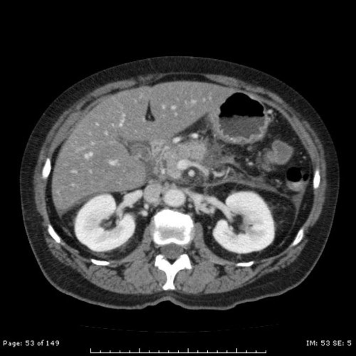 CT of abdomen with intravenous contrast. Notice how much better you can see the kidneys and blood vessels.
