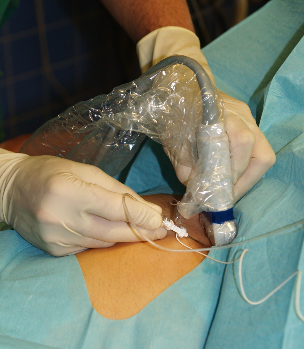 Femoral nerve block being placed with the use of an ultrasound probe to guide the needle toward, but also to protect, the nerve. Other techniques also provide safe and effective blocks.