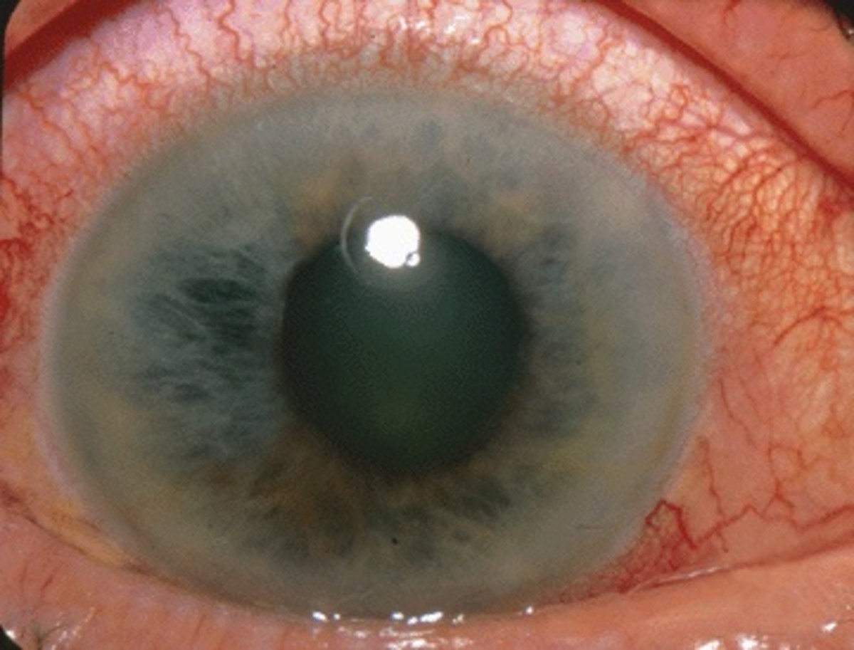 An eye with angle closure glaucoma.