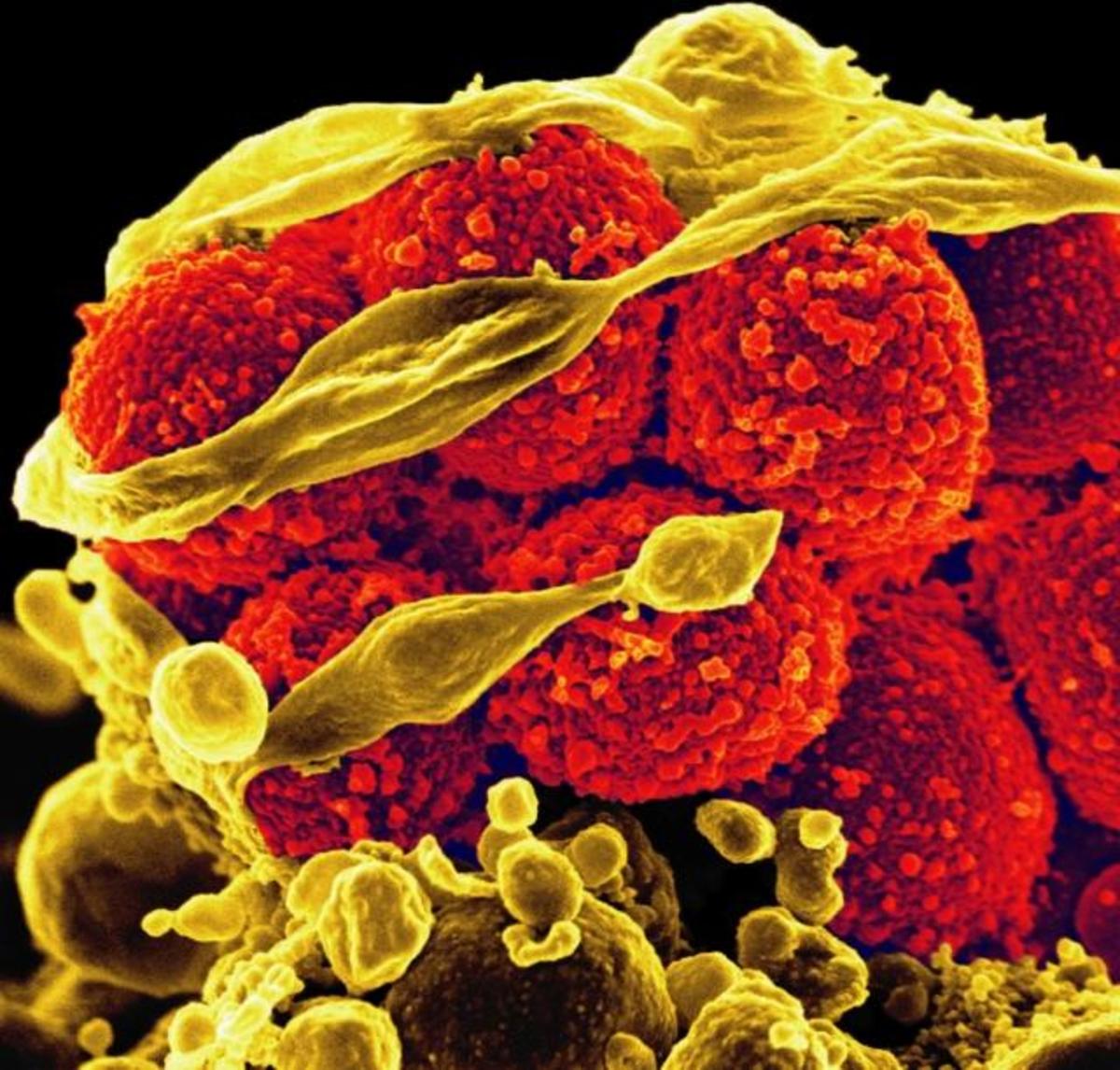 Scanning electron micrograph of methicillin-resistant Staphylococcus aureus bacteria (yellow, round items) killing and escaping from a human white cell. Credit: NIAID