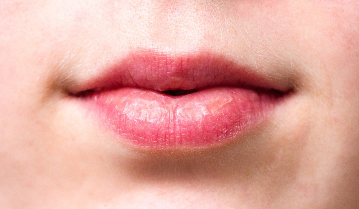 Chapped lips can be very painful.