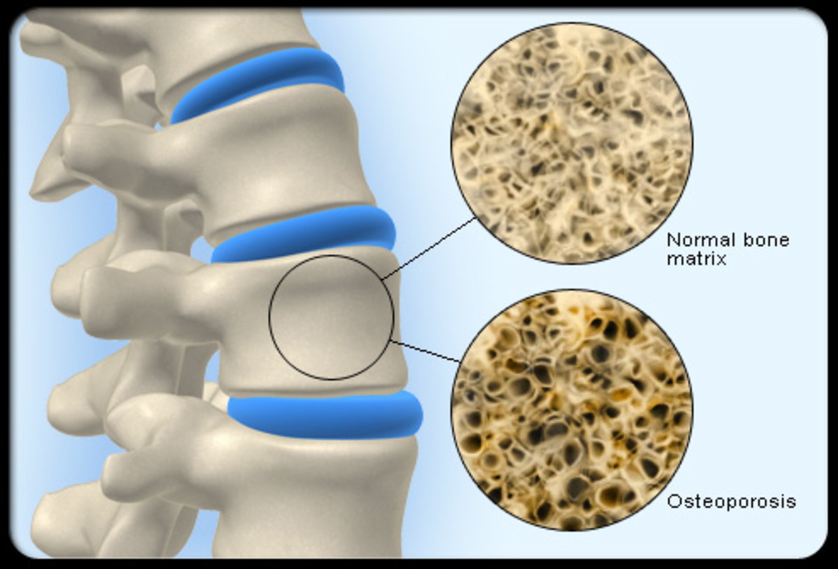 Osteoporosis is often a symptom of menopause. Source: Wikimedia