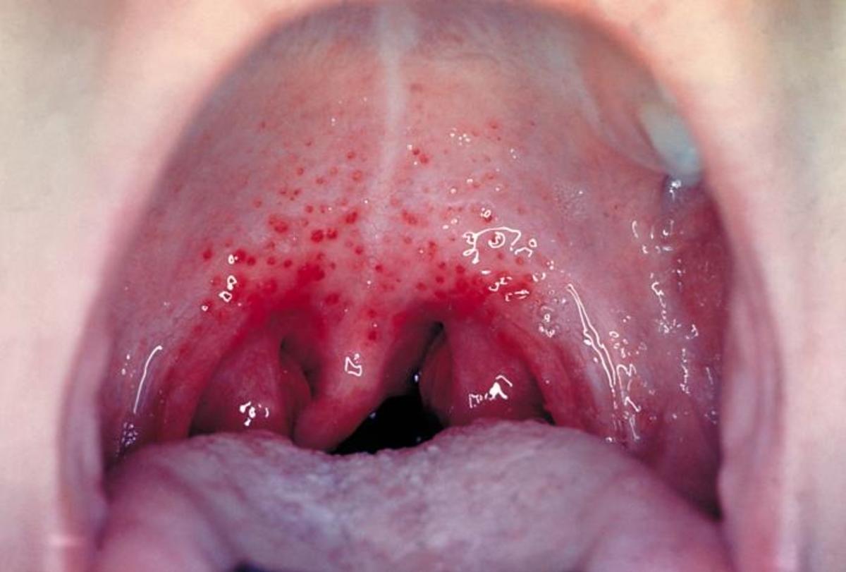 Severe sore throat with infection