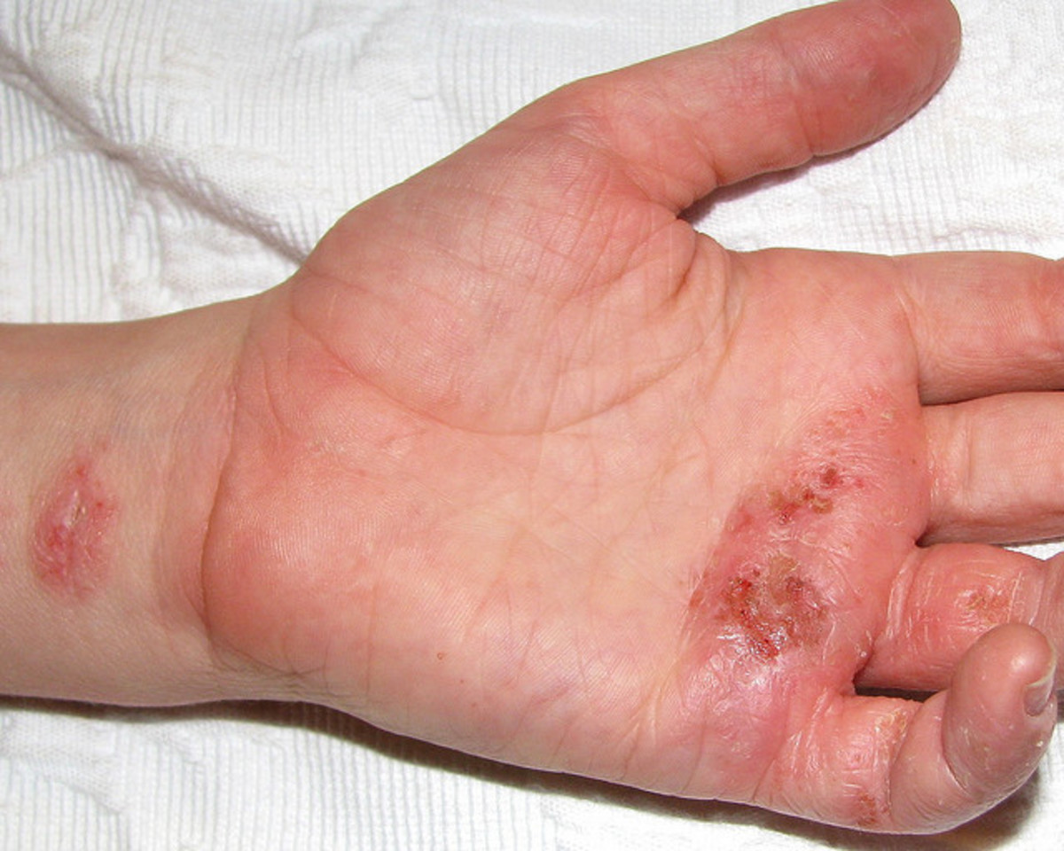 This is a more severe case of contact dermatitis. 
