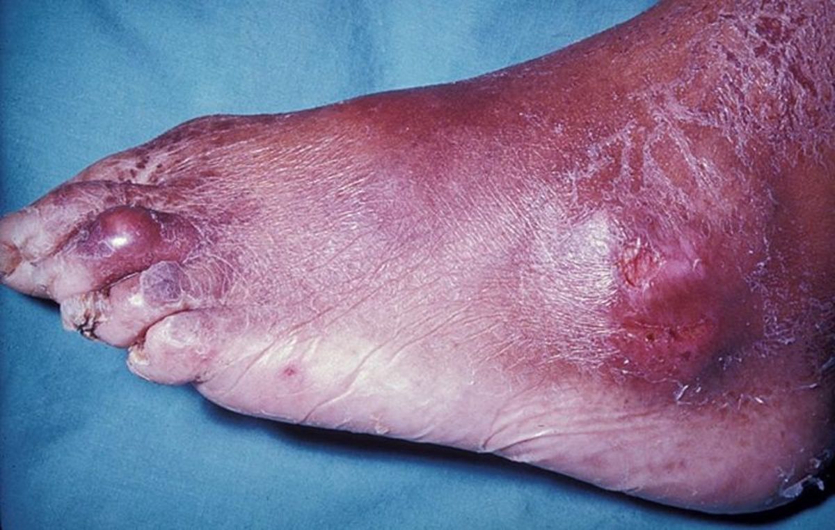 Here's a photo of another bad case of the gout. 