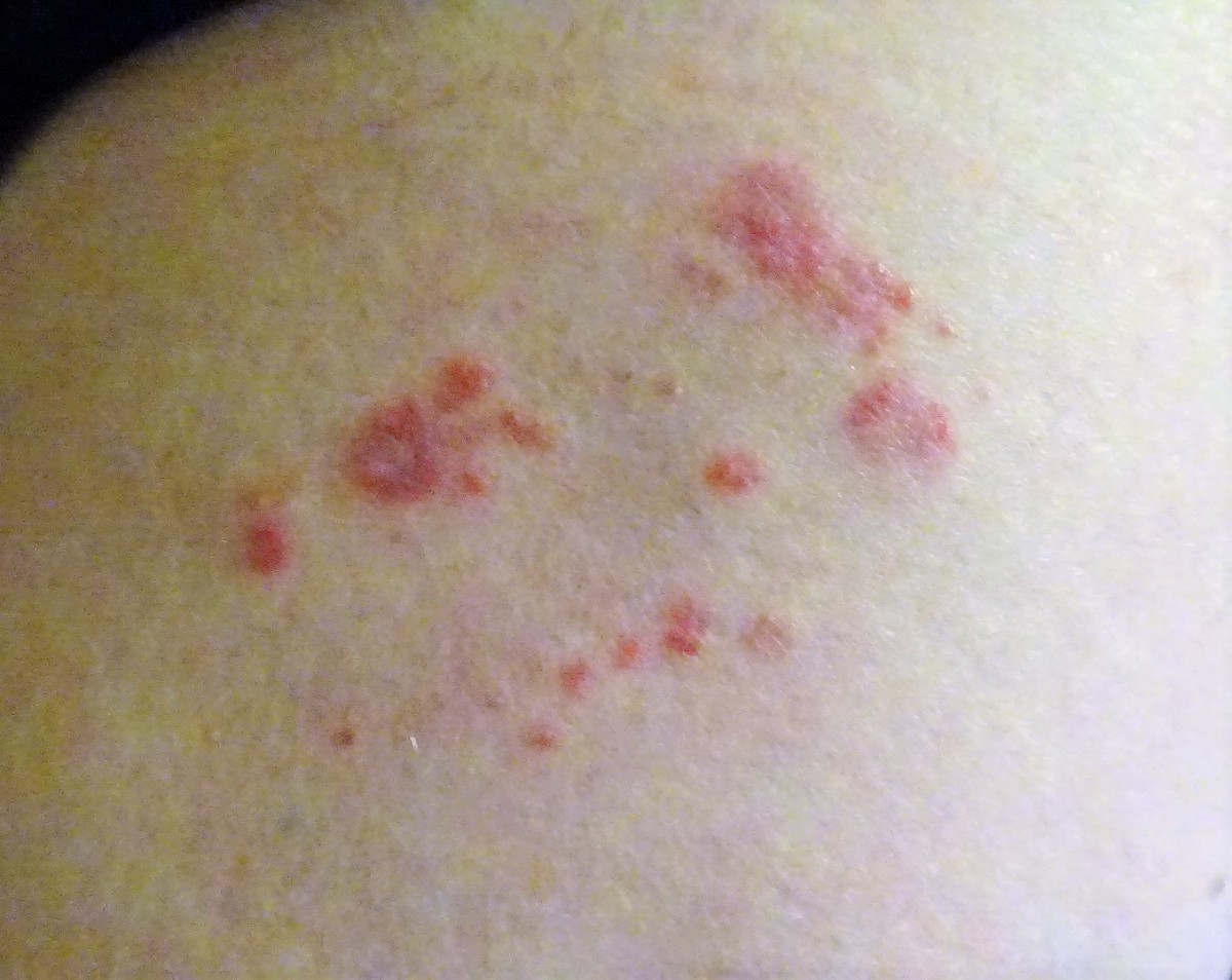 Shingles rash looks very much like other herpes rashes. Shingles can be very painful. If you have had chicken pox, you carry the shingles virus.