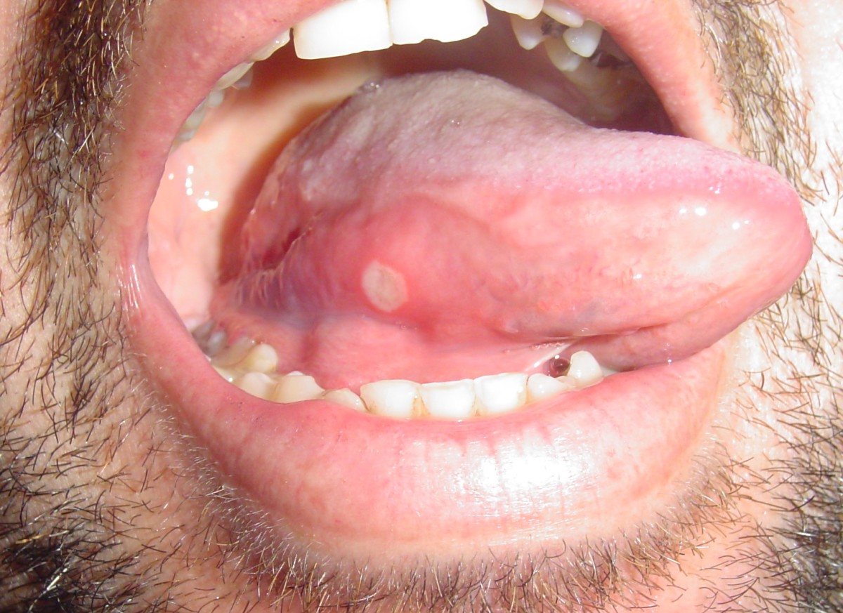 A tongue ulcer on the side of the tongue
