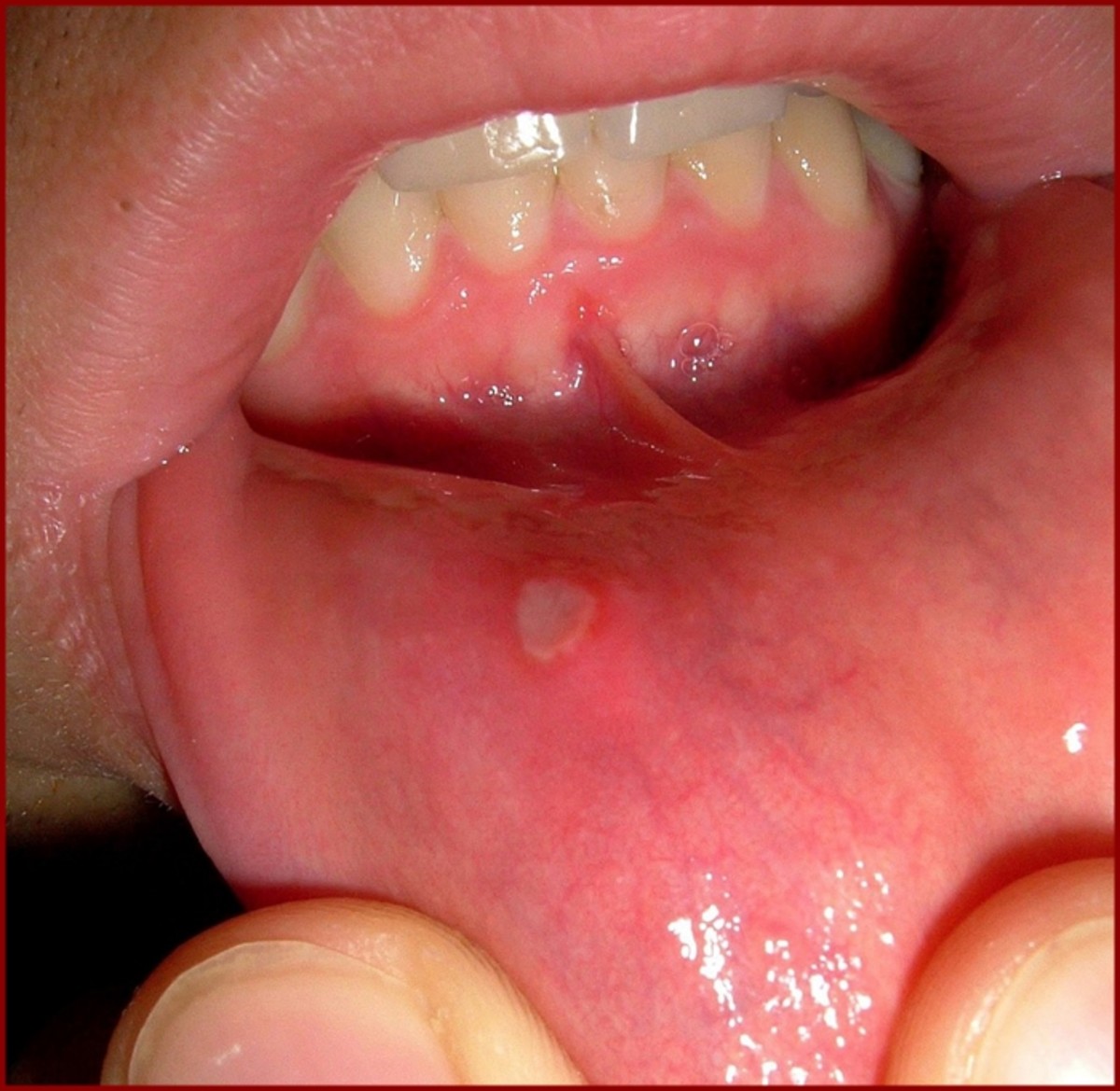 Mouth ulcer inside the lip