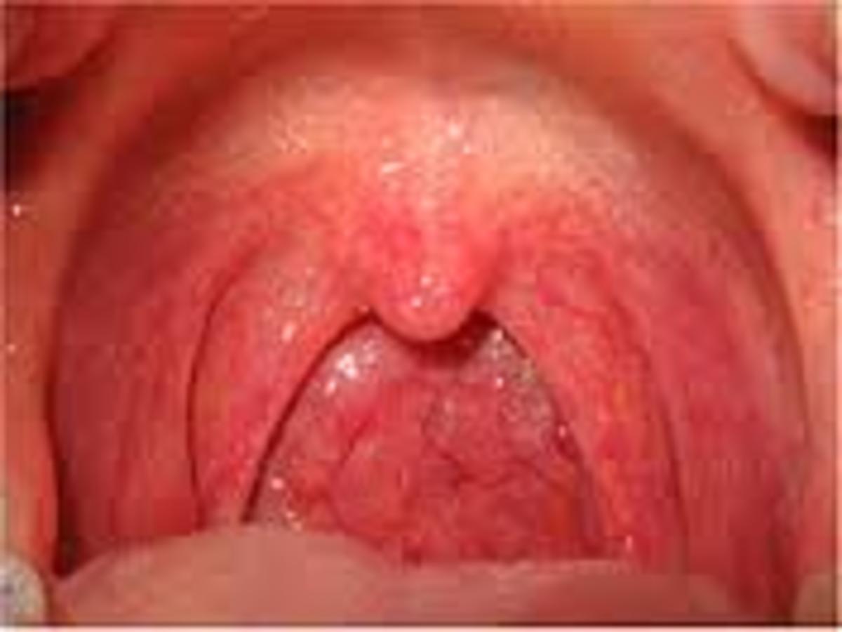 Sore throats commonly occur in the winter months and can be acute or chronic.