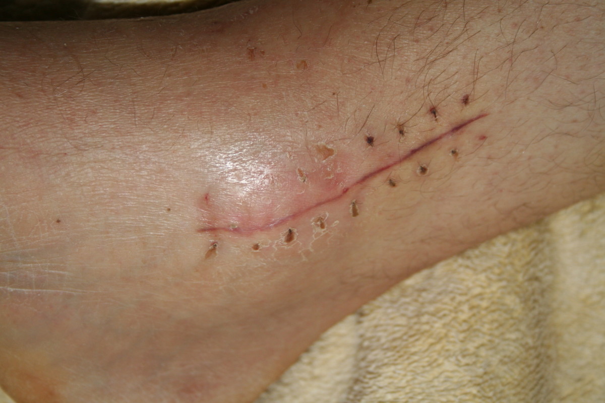 This photo was taken two days after the surgical staples were removed. Comfrey poultice was applied to the ankle and left for about six hours before washing it off. Look at the difference between 'before' and 'after' photos.