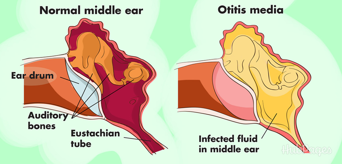A normal vs. an infected ear.